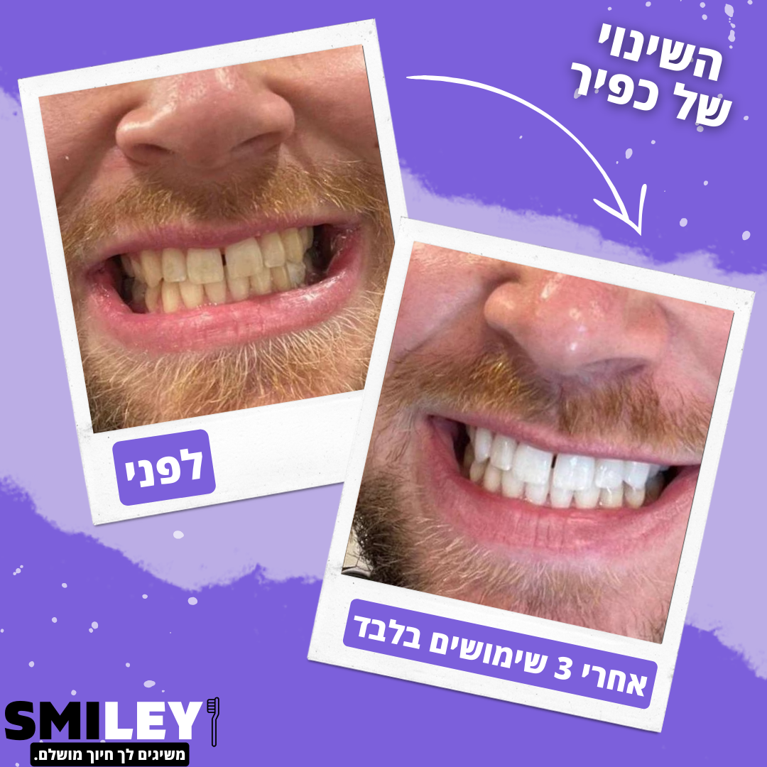 SmileyKIT™ - ערכת ההלבנה