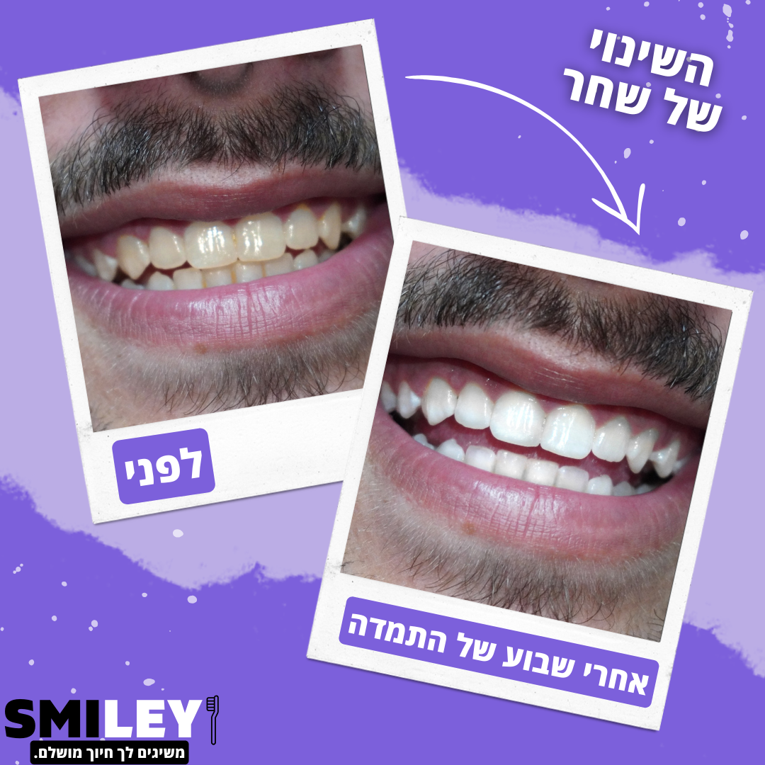 SmileyKIT™ - מארז הלבנה