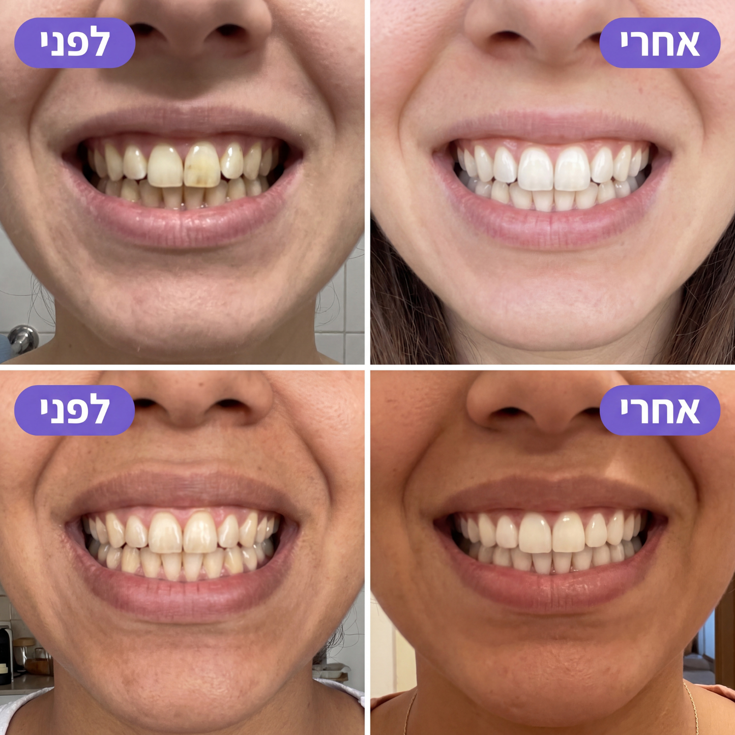 SmileyWhite™ - רצועות סגולות להלבנה מיידית
