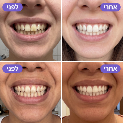 SmileyWhite™ - רצועות סגולות להלבנה מיידית